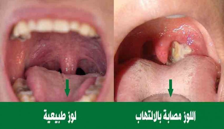 سحر علاج التهاب اللوزتين بالليمون والشاي